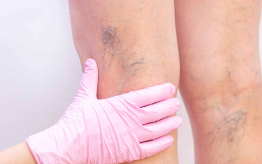 “Flebología kinésica, edema y piernas cansadas” por Lic. Verónica Sumaran