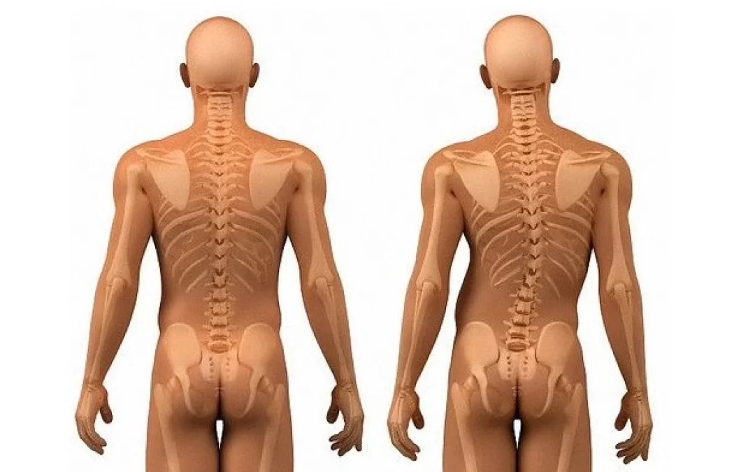 “Qué es la Escoliosis Idiopática, y la forma de detectarlo”