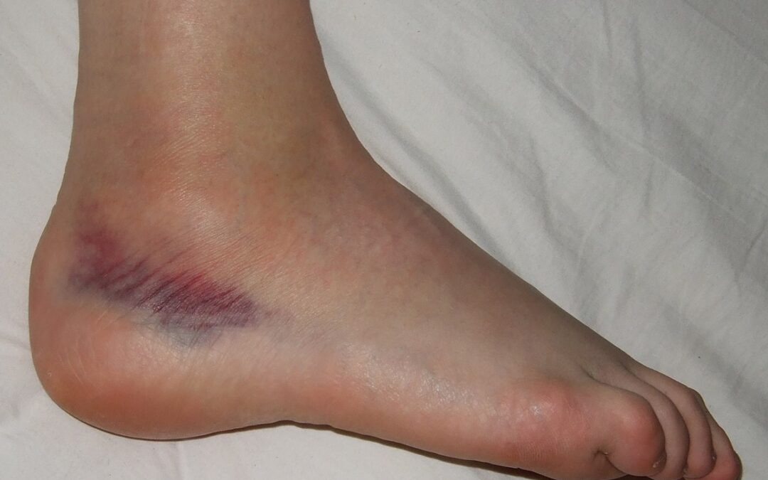 Esguince de tobillos