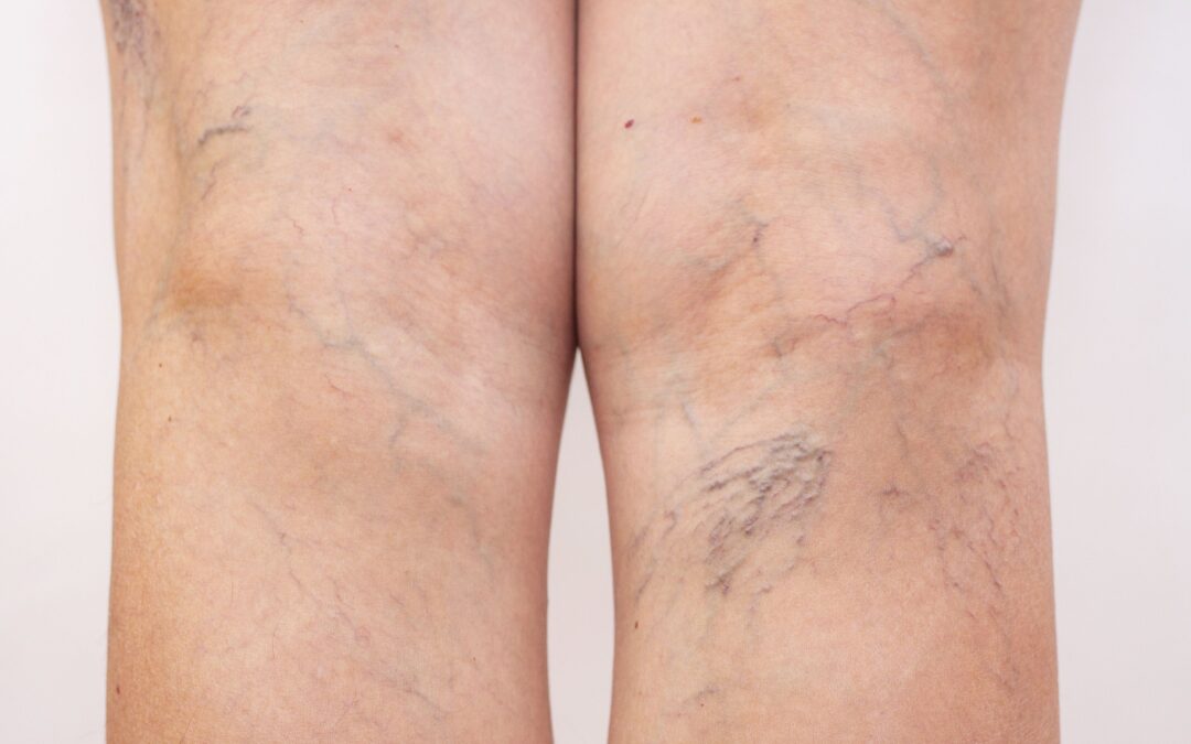 Insuficiencia venosa, piernas cansadas