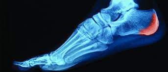 “Espolón calcáneo versus fascitis plantar”