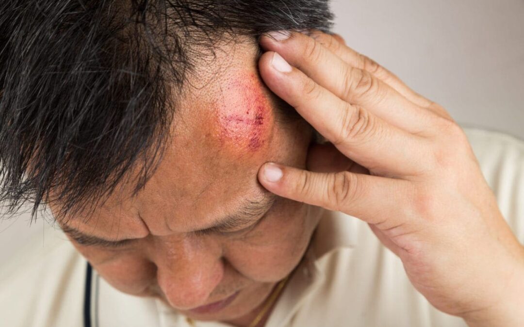 “Vértigo posterior a un golpe en la cabeza”